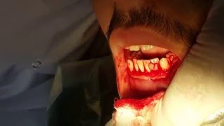 Gingivectomy  Dr Muhammed I Hazeem [upl. by Heymann]