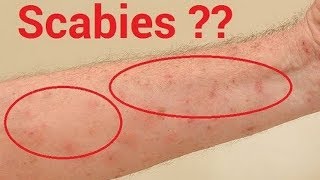 How To Know If You Have Scabies And 7 Natural Treatments That Work Fast [upl. by Kabab143]