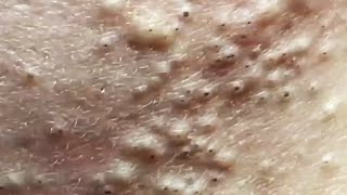 Blackheads amp Whiteheads Satisfying Removal 0056 [upl. by Labinnah]