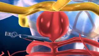 Aneurysm in the Brain and Clipping  3D medical animation  ABP © [upl. by Gibbeon]