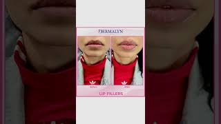 Russian lip filler 💉1 ml  for appointments or whatsapp us at 9311691081  9999189391 [upl. by Adoc861]