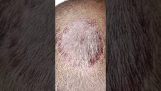 Example of tinea capitis  tinea tineacapitis medical fungalinfection shorts [upl. by Ydnal957]