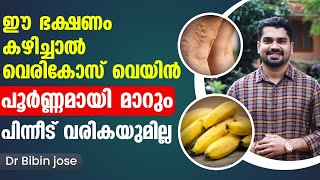 ഈ ഭക്ഷണങ്ങൾ കഴിച്ചു വെരികോസ് വെയ്ൻ പൂർണമായി മാറ്റം Vericose Treatment in Malayalam Dr Bibin Jose [upl. by Ronoel]