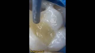 how to fil dental teeths filing procedure [upl. by Nodnarg]