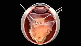 Retinal Detachment  Signs Symptoms and Treatment [upl. by Abey]