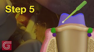 Applying Bonding Agent BEFORE Zirconia Crown Cementation [upl. by Jonis]