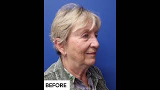 MiniFaceliftNecklift Before and After  Avance Plastic Surgery Dr Erez Dayan  Reno Tahoe NV [upl. by Edwards339]