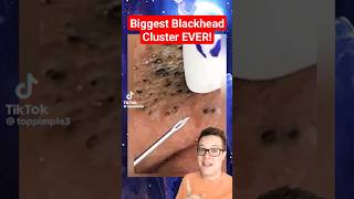 BIGGEST BLACKHEADS REMOVAL EVER  Extreme Blackheads on Cheek shorts [upl. by Ayahsal243]