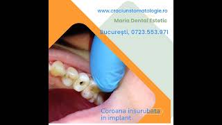 Coroana zirconiu insurubata in implant [upl. by Hazrit]