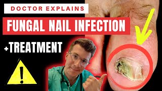 How to recognise diagnose amp treat FUNGAL NAIL INFECTION Onychomycosis  Doctor ODonovan explains [upl. by Fenwick]