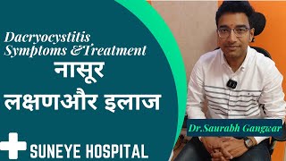 नासूर लक्षणऔर इलाज Dacryocystitis Symptoms ampTreatment [upl. by Enitsyrhc]