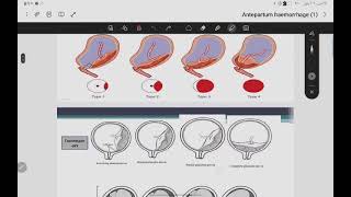 نسائية  Antepartum haemorrhage [upl. by Niletak]