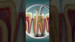 Root Canal Treatment  Curveia Dental I RCT [upl. by Eberta]