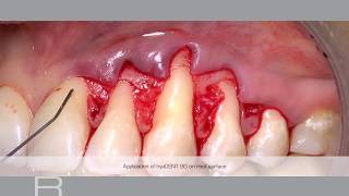 Treatment of gingival recession with a Coronally Advanced Flap by Prof Andrea Pilloni [upl. by Whyte]