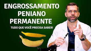 Engrossamento peniano permanente  Tudo que você precisa saber  Dr Marco Túlio Cavalcanti [upl. by Ikkiv]