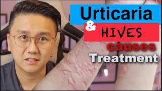 URTICARIA amp HIVES  Causes and Treatment of Itchy Skin Rash [upl. by Tonneson]