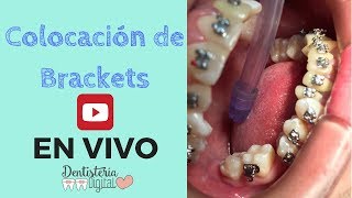 COLOCACIÓN DE BRACKETS EN VIVO  Apiñamiento Superior e inferior [upl. by Yreneh]