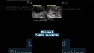 Ultrasound placental localization ultrasound doctor mbbs pregancyultrasound baby [upl. by Assirolc743]