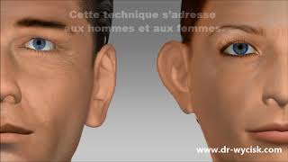 Technique earfold pour les oreilles décollées  Dr Wycisk [upl. by Hujsak]