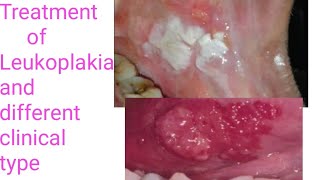 Treatment of LeukoplakiaTypes of Leukoplakia Different treatment modalities of Leukoplakia PVLVH [upl. by Eatnuahc843]