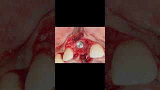 Immediate Implant placement  Luxator extraction Osseodensification  Bone Grafting PERIO SUBHARTI [upl. by Nerok]