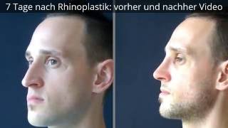 7 Tage nach Rhinoplastik vorher und nachher Video [upl. by Madigan]