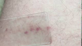 Glass test  Meningitis rash [upl. by Zeb]