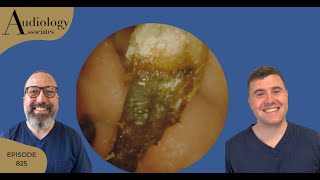 MASSIVE ECZEMA EAR WAX REMOVAL amp DIFFICULT DEEP EAR WAX PLUGS  EP825 [upl. by Danby]