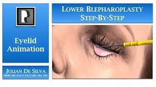 Blepharoplasty Animation – How is Lower Blepharoplasty Eyelid Surgery completed [upl. by Atiz543]