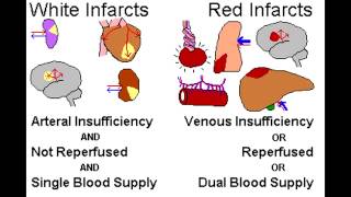 Infarcts Red vs Pale [upl. by Rodolphe495]