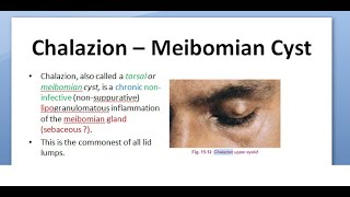 Ophthalmology 376 Chalazion Meibomian Cyst triamcinolone DIATHERMY tetracycline MALIGNANCY Eyelid [upl. by Feldstein123]