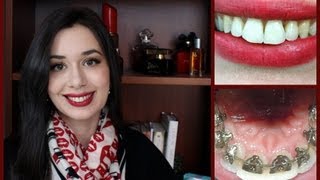 • Incognito Lingual Braces Treatment Final Reveal and Review [upl. by Sculley775]