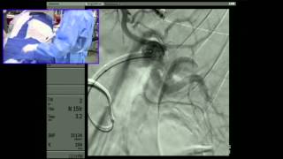 Transradial Embolization of a Splenic Artery Aneurysm  Part 2 Embolization  6 min cut [upl. by Wilhelm24]