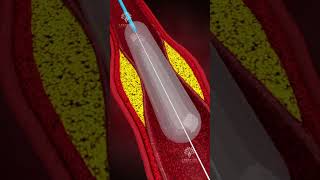 How Does Coronary Angioplasty Work  Blocked Arteries Treatment shorts  creativelearning3d [upl. by Lalo]