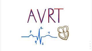 Atrioventricular Reentrant Tachycardia AVRT SVT ECGTUTORIAL cardiology medicalstudents AVNRT [upl. by Nuahsor684]