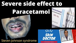 PARACETAMOL can cause severe drug allergy and Death Steven johnson syndrome TEN Drug reaction [upl. by Cheng]