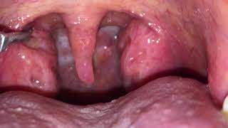 HUGE TONSIL STONES REMOVED [upl. by Auqenaj]