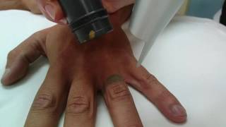 Laser Tattoo Removal  Laser Skin Care Australia [upl. by Namaan]