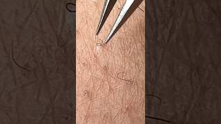 evict INGROWN HAIRS in 2 Steps ingrownhair sugarwax hairremoval [upl. by Garcon]