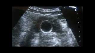 ultrasound how to scan PROSTATE 1 0F 3 [upl. by Etakyram]