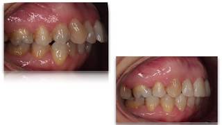 Ortodoncia dientes adelantados Clase 2 con extracciones [upl. by Cecelia]