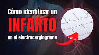 Cómo identificar un infarto agudo de miocardio en el electrocardiograma [upl. by Asiak]