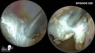 229  This patient attended with a suspected benign osteonecrosis and otomycosis [upl. by Ariak]