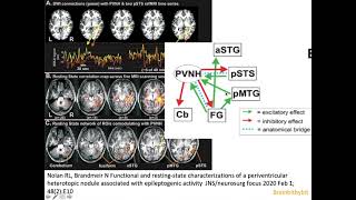 7 Heterotopia epilepsy PVNH malformation cortical development filamin CDK5 MRI neuroradiology [upl. by Tnaryb]