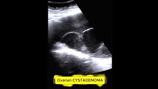 OVARIAN CYST ADENOMA mass infertility ovarian [upl. by Izogn]