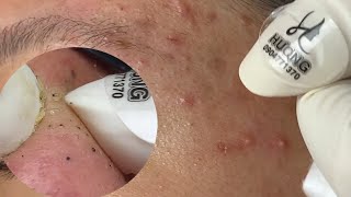 Acne Treatment Huong Da Nang  588  Thank you everyone [upl. by Brouwer824]