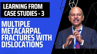 Learning from Case Studies  3 Multiple metacarpal base fractures with CMC joint dislocations [upl. by Yremogtnom]