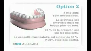 Implants dentaires  Prothèse amovible sur barre [upl. by Einohtna]