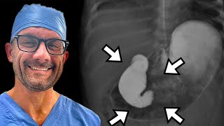 Why is Malrotation and Volvulus so Dangerous [upl. by Helprin2]