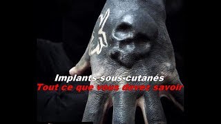 Implants sous cutanés  Tout ce que vous devez savoir [upl. by Henrie86]